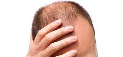 के कारणले पुरुषको मात्र तालु खुइलिन्छरु जान्नुहोस् वैज्ञानिक कारण